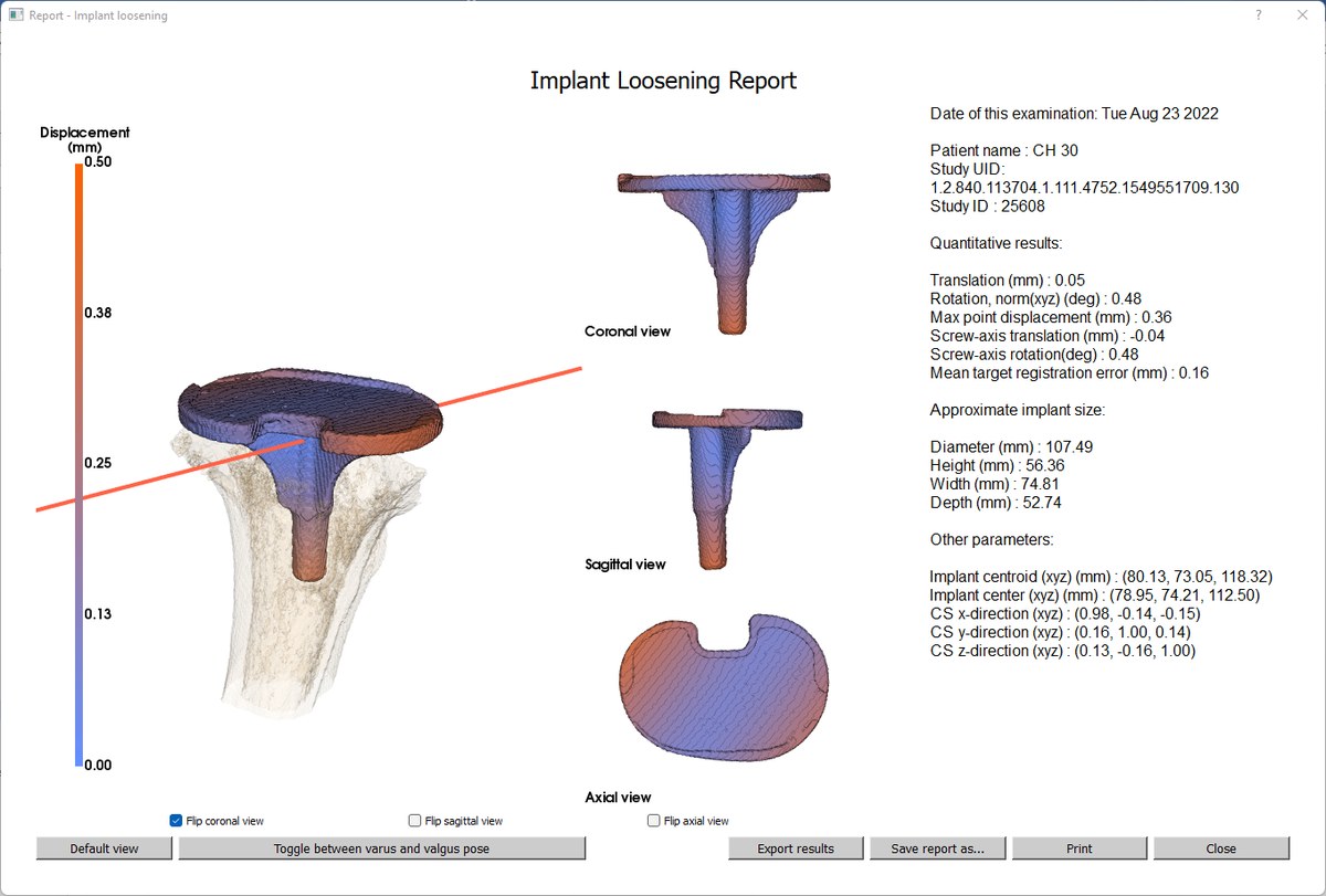 AtMoves implant loosening report showing the tibial component and quantified displacement values